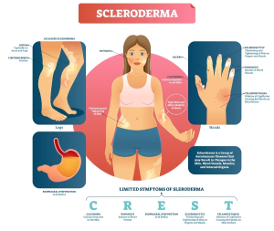 sintomi della sclerodermia