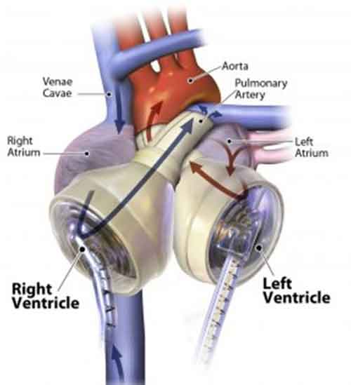 cuore artificiale1