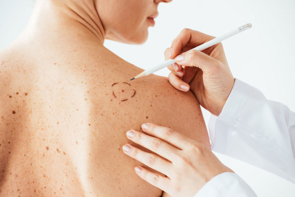 vaccino contro il melanoma