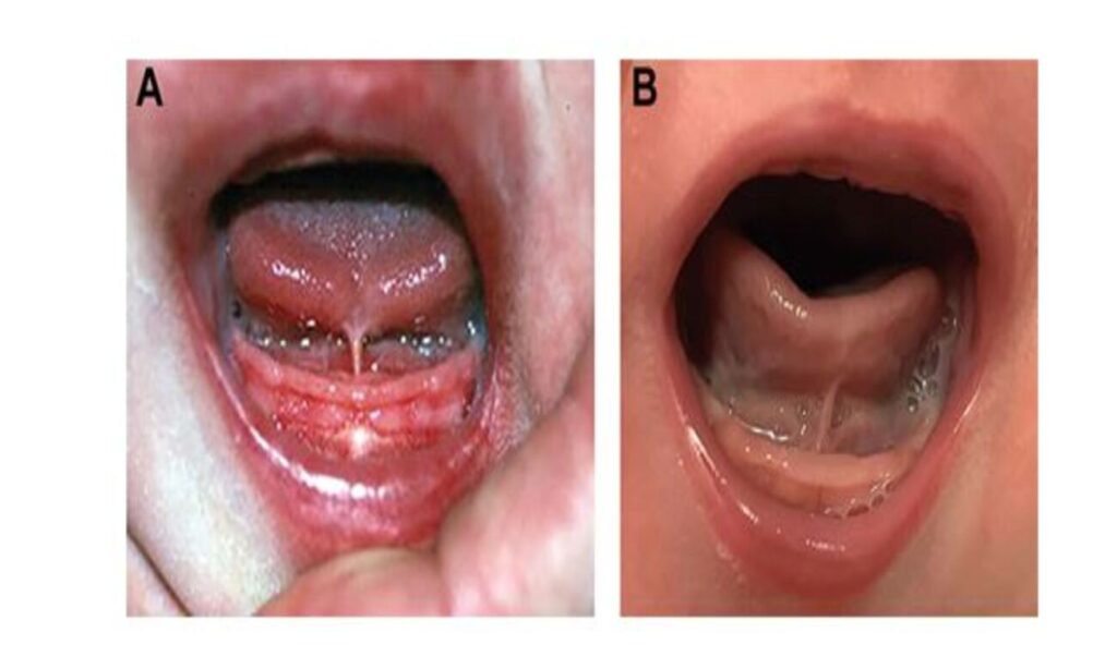 frenulo lingua neonatale 1