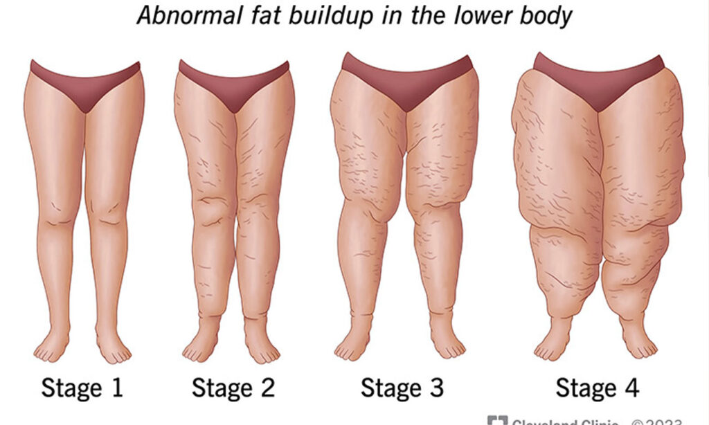 lipedema